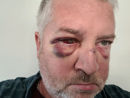 PEF member Joe Robinson shared this photo of his facial injuries following the assault at OCFS Industry in Oct. 2023.